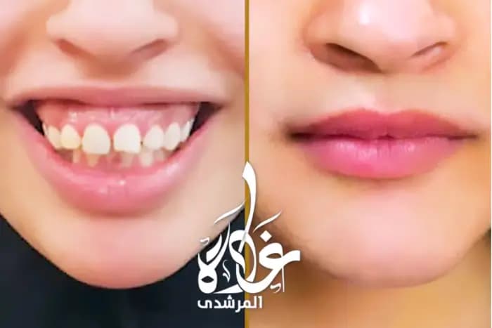 Gummy smile and jaw protrusion, successfully corrected, Before / After