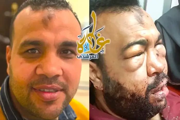 Multiple fractures across the whole face, Before / After