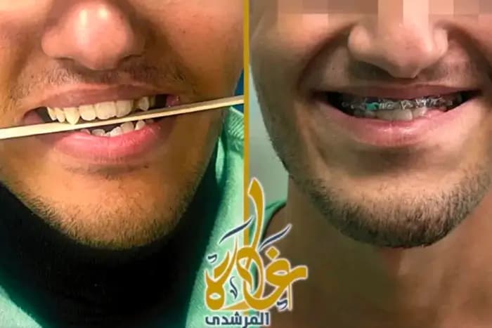 Difficulty chewing and speaking, a misaligned bite, breathing difficulties and jaw joint disorders are signs that corrective jaw surgery may be needed, Before / After
