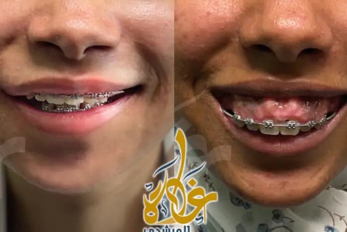 A gummy smile case, Before / After
