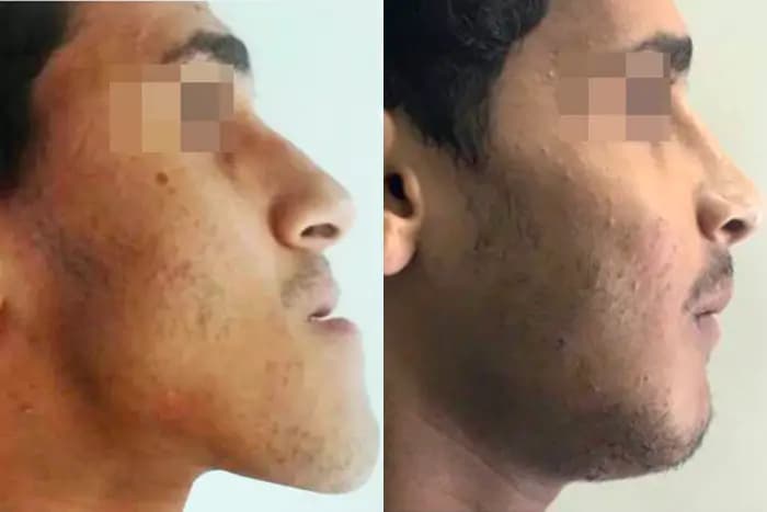 Jaw line alignment, Before / After
